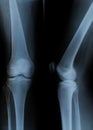 Knee Xray with 4 visible bones Royalty Free Stock Photo