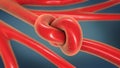 Knot in an artery being constricted and narrowed called arteriosclerosis Royalty Free Stock Photo