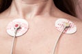 Electrodes of an electrocardiograph are glued on a woman chest