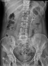 KUB x-ray showing double j stent left kidney to bladder