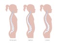 Kyphosis, lordosis flat vector illustration. Royalty Free Stock Photo