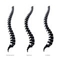 Kyphosis, lordosis flat vector illustration. Royalty Free Stock Photo