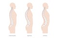 Kyphosis, lordosis flat vector illustration. Royalty Free Stock Photo