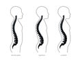 Kyphosis, lordosis flat vector illustration.