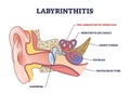Labyrinthitis as inner ear infection and medical inflammation outline diagram Royalty Free Stock Photo