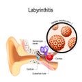 Labyrinthitis. inflammation of the inner ear and Herpes simplex virus that caused this disease Royalty Free Stock Photo