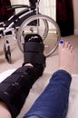 Lady with Fractured Leg Royalty Free Stock Photo