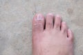 Lap Feet Or Flat Foot