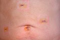 Laparoscopic Cholocystectomy Scars Royalty Free Stock Photo