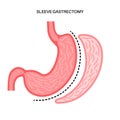 Laparoscopic sleeve gastrectomy