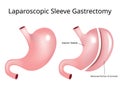 Laparoscopic Sleeve Gastrectomy / Weight loss surgery - Vector