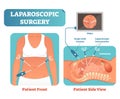 Laparoscopic surgery medical health care surgical procedure process, anatomical cross section vector illustration diagram. Royalty Free Stock Photo
