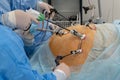 Endoscopy. Laparoscopy. The hands of doctors using laparoscopic instruments perform surgery in the abdominal cavity of a fat man