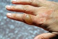 Scald blister on a finger. Royalty Free Stock Photo