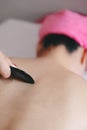 Gua-Sha Acupuncture Treatment on Back Royalty Free Stock Photo