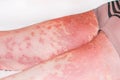 Large inflamed,scaly rash on man's legs.Acute psoriasis, severe reddening of the skin,an autoimmune,incurable