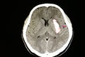 large intracerebral hematoma Royalty Free Stock Photo