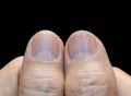 Large lunulae or half-moon at fingernail with vertical lines of Asian, Chinese old man