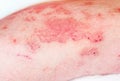 Large red,inflamed,scaly rash on man's legs.Acute psoriasis, severe reddening of the skin,an autoimmune,incurable