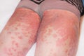 Large red,inflamed,scaly rash on man's legs.Acute psoriasis, severe reddening of the skin,an autoimmune,incurable
