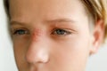 Large red rash on the nose and over the child\'s eye - dermatolonia, infection, herpes, mucous membrane, selective focus Royalty Free Stock Photo