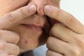 Large ripe pimple on a man`s face