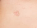 Large scar and scar on the patient`s skin after removing an inflamed pimple, close-up, professional