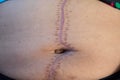 Big keloid scar