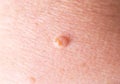 Large wart on the skin of a person, background, macro, dermatology