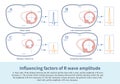 Influencing factors of R wave amplitude Royalty Free Stock Photo