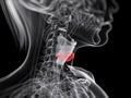 Larynx cancer Royalty Free Stock Photo