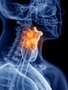 Larynx cancer Royalty Free Stock Photo