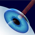 Laser Eye Correction