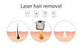 Laser hair removal concept with skin and hair areas. Stages of the removal procedure.