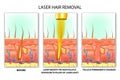 Laser hair removal