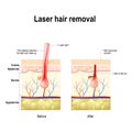 Laser Hair Removal. Vector diagram