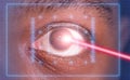 Laser or lasik eye surgery concept, laser beam shining into african america male dark brown eyes