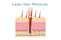 Laser light for hair removal on skin layer.