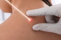 Laser mole removal. Doctor checking patient's skin during procedure in clinic, closeup