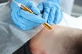 Laser removal of a mole on man neck in beauty salon Royalty Free Stock Photo