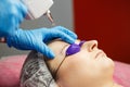 Laser removal of tattoo eyebrows Royalty Free Stock Photo