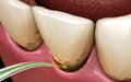 Laser removes a thin layer of infected skin, teeth cleaning. Medically accurate tooth 3D illustration