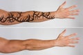 Laser Tattoo Removal Before And After Royalty Free Stock Photo