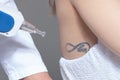 Laser tattoo removal in clinic closeup