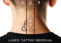 Laser tattoo removal. Close up. on white background Royalty Free Stock Photo