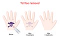 Laser tattoo removal