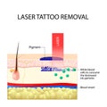 Laser tattoo removal.