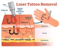 Laser Tattoo Removal Vector Illustration Diagram. Cosmetic Dermatology Visual Information.