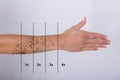 Laser Tattoo Removal On Woman`s Hand Royalty Free Stock Photo