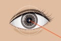 Of laser vision correction.